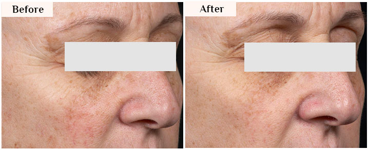 clear+brilliant laser before after